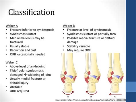 Different Types Of Ankle Fractures