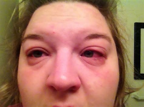 Swelling Eye Punch In The Face Hashimotos Disease Swollen Eyes My Xxx Hot Girl