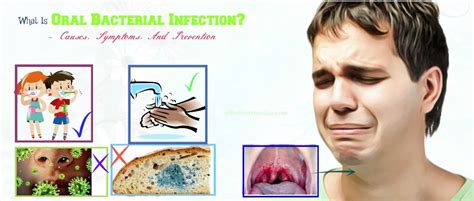 What Is Oral Bacterial Infection Causes Symptoms Prevention