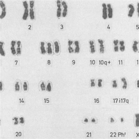 The Karyotype Of The Leukemic Blood Cell Of Patient S V Cml