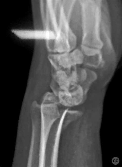 Learningradiology Barton Fracture Dislocation Radius Distal My XXX Hot Girl