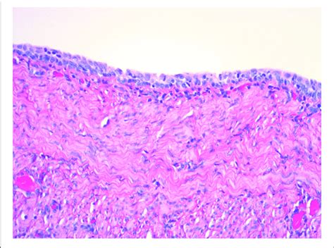 Histologic Appearance Of Vaginal Cystic Structure With Stratified