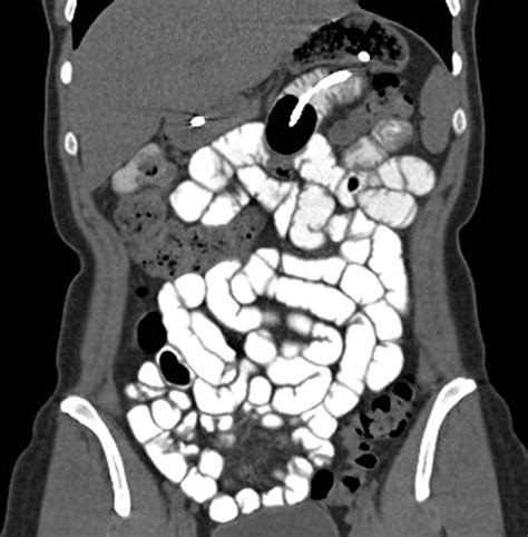 Ct Enterography As A Diagnostic Tool In Evaluating Small Bowel