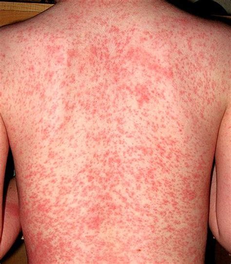 48 Best Rash Images On Pinterest Arms Autoimmune Diet And Baby
