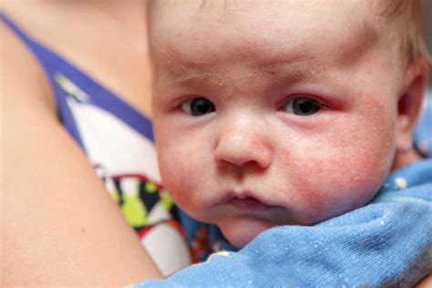 When Does Eczema Start In Babies
