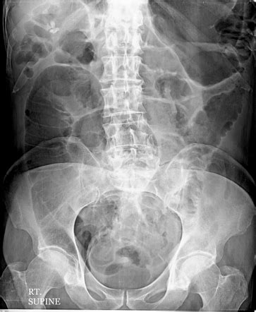 Bowel Obstruction Radiology Reference Article Radiopaedia Org