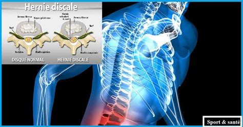 L Hernie Discale Sympt Mes Et Traitement Health Intervertebral Disc Spinal Disc Herniation