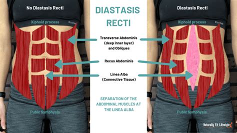 Diastasis Recti Rectus Abdominis Muscle Abdomen Physical Therapy Png
