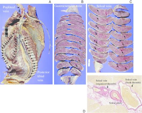 A Representative Case A Extracted Popliteal Vein And Calf Veins With