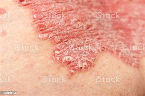 Detail Of Psoriatic Skin Disease Psoriasis Vulgaris With Narrow Focus