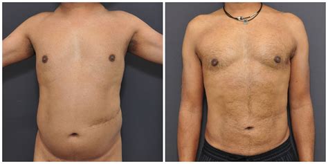 Liposuction For Men San Francisco David Sieber Md