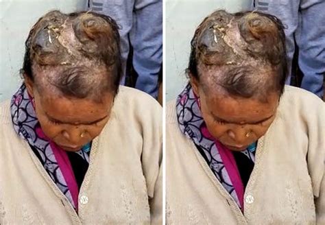 Indian Woman Begins To Grow Horn On Her Head At 60 Plenty Photos