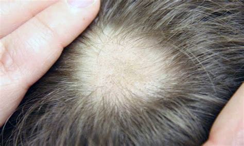 Alopecia Areata Di Cosa Si Tratta TricoRepair