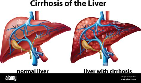 Cirrhosis Of The Liver Poster Stock Vector Image And Art Alamy