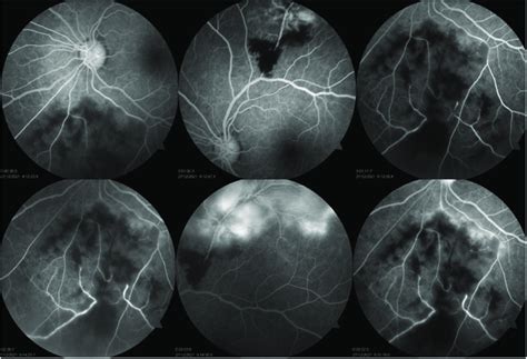 A And B Fundus Fluorescein Angiography Of The Left Eye Performed