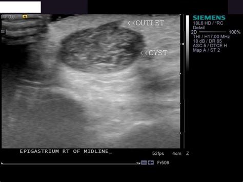 Ultrasound Imaging Ultrasound Study Of Sebaceous Cyst