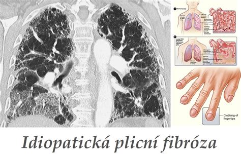Idiopatická Plicní Fibróza Příznaky Projevy Symptomy Příčina