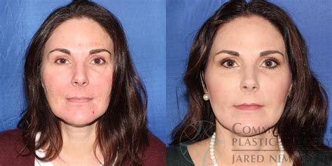 Neck Liposuction In Lexington And London Ky Commonwealth Plastic Surgery
