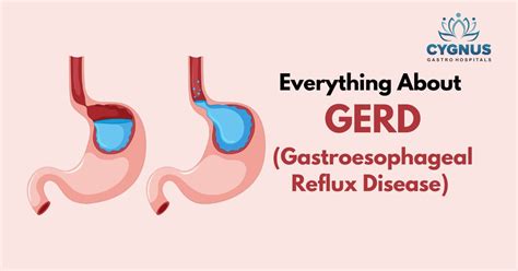 Gerd Risk Factors Symptoms Diagnosis And Treatment Cygnus Gastro