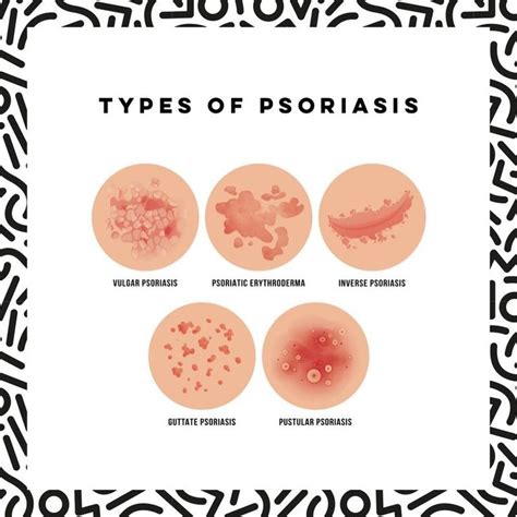 Types Of Psoriasis Psoriasis Pustular Psoriasis Types Of Psoriasis