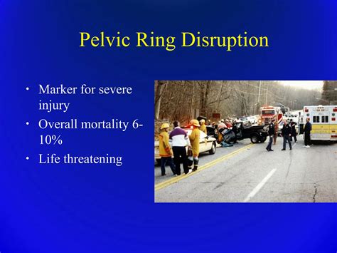 Trauma Pelvic Fracture Ortho Prespective Ppt Free Download