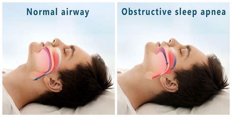 sleep apnea symptoms and your health dr aragona