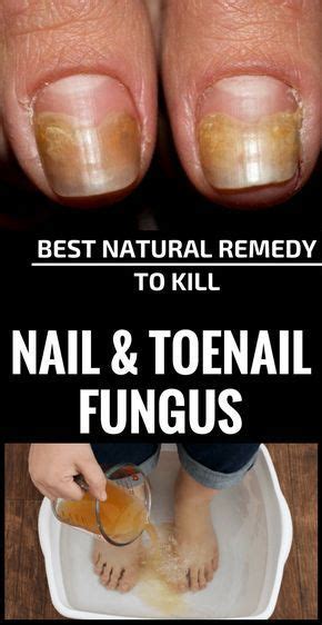 Best Natural Remedy To Kill Nail And Toenail Fungus Thebeautymania