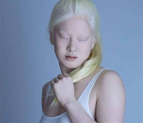 Abandoned Albino Baby Ends Up Becoming A Vogue Model Elite Readers
