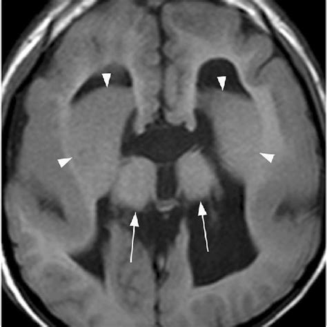 Primary Familial Brain Calcification A 30 Year Old Male With Primary