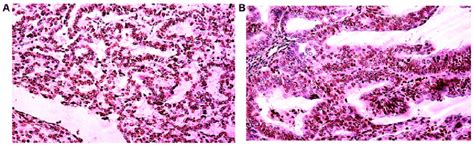 Positive Immunohistochemical Pten Staining Patterns In Endometrial