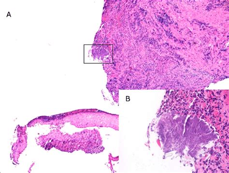 Esophageal Biopsy A Histological Examination Of A Hematoxylin And