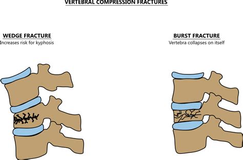 Compression Fracture