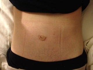 Hamilton surgical arts in indianapolis, in explains what the tummy tuck marble trick is and why you shouldn't need a marble to achieve a beautiful belly button. Why Does My New Belly Button Seems a Little Odd over a ...