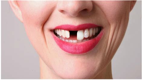 Awesome How To Make Your Teeth Grow In Just Few Weeks 3inaa