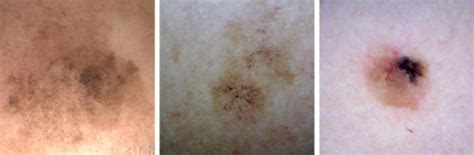 What Does Melanoma Look Like Molemap