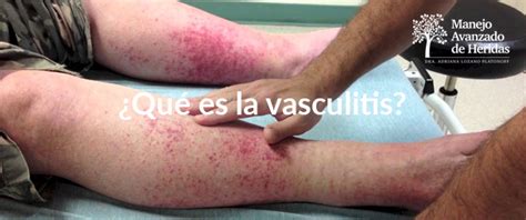 ¿qué Es La Vasculitis Curación De Heridas