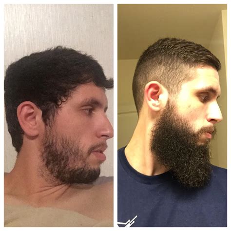 Patchy Beards Before And After