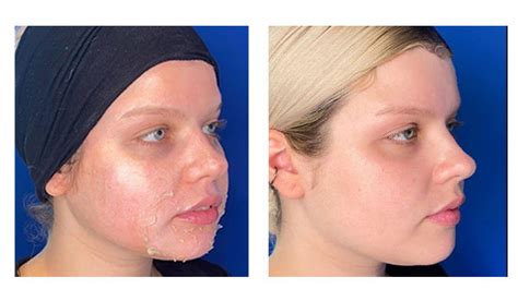 The Perfect Derma Peel Chesapeake Laser And Skin Care Center