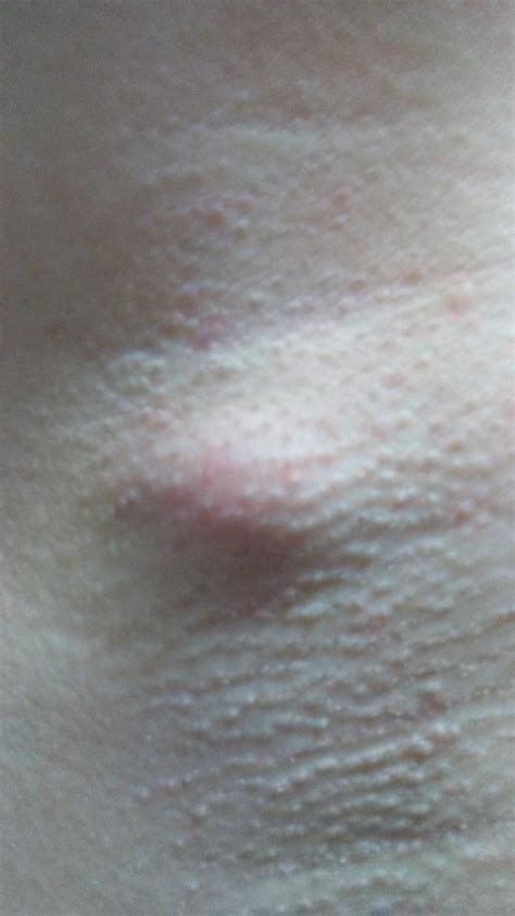 Armpit Bumps Painful