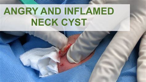 Angry Inflamed Neck Cyst Dr Derm Youtube
