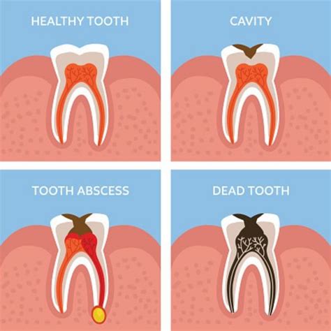 Tooth Abscess Symptoms What Is A Dental Abscess How Do You Fix It