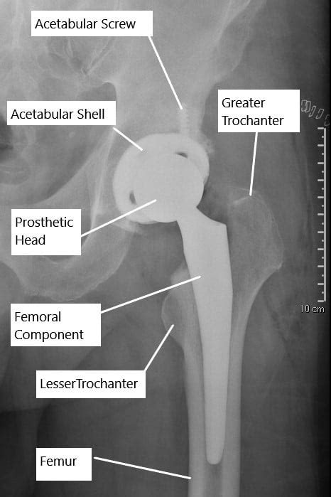 Uncemented Vs Cemented Total Hip Replacement Complete Orthopedics