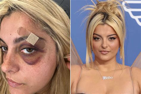 bebe rexha shares photo update of her bruised eye after onstage assault