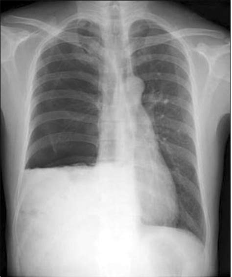 Decreased tactile fremitus and dullness to percussion would be found in a. Chest X-ray shows right-sided pneumothorax and pleural ...
