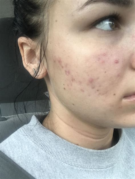 Tips and routine/product suggestions for acne with very dry skin? My