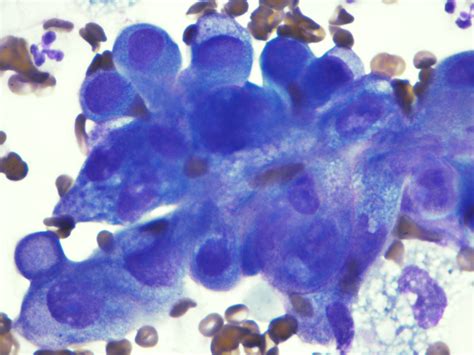 Anidap Cytologymetastatic Lung Tumor Mammary Adenocarcinoma