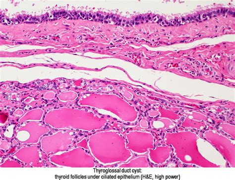 Pathology Outlines Thyroglossal Duct Cyst
