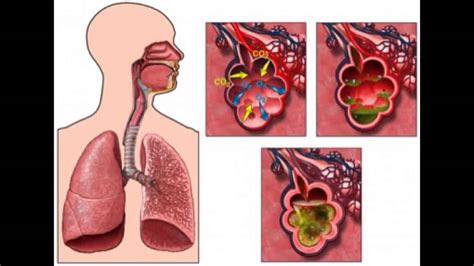 Bronquitis Causas S Ntomas Y Tratamiento Bronquiolitis Tratamiento