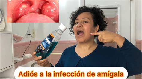 🔴cómo Eliminar La InfecciÓn Y El Dolor De AmÍgdalas Anginas100