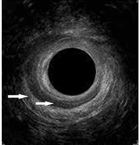 Endoanal Ultrasound Image The Hyperechoic Outer Circle Is The External Download Scientific